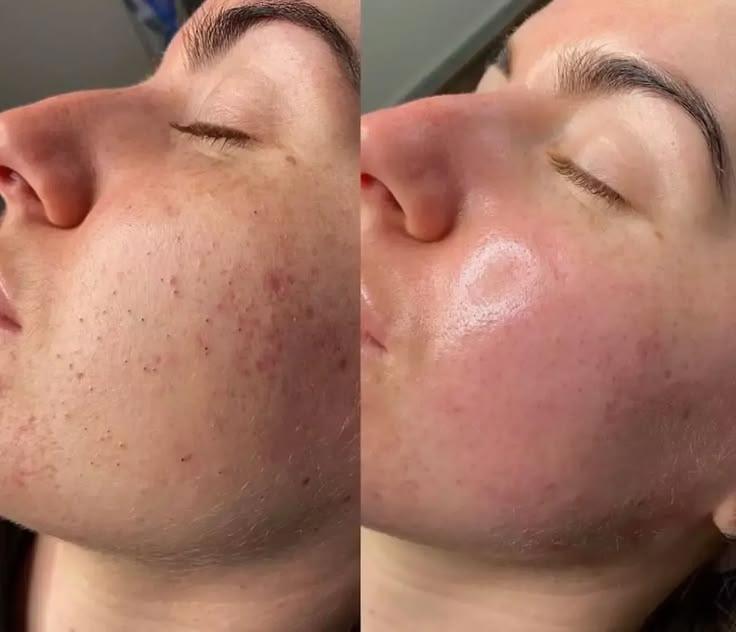 Before and After of the Anti-Acne Teen Facial at Veronika's Aesthetics