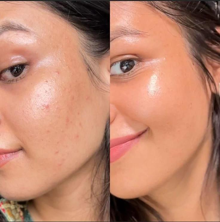 Before and After of a happy teen with clear skin due to 6 sessions of Veronika's Aesthetics' Anti-Acne Teen Facial